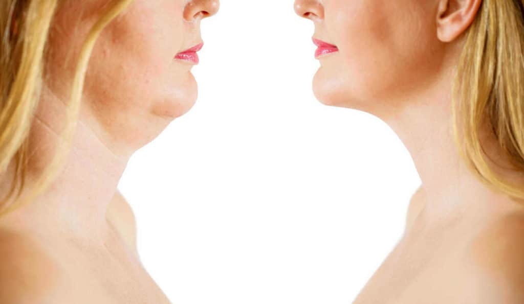 Double Chin treatment Shepperton before and after results