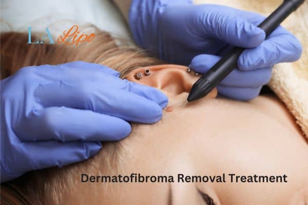 Dermatofibroma Removal Treatment Shepperton
