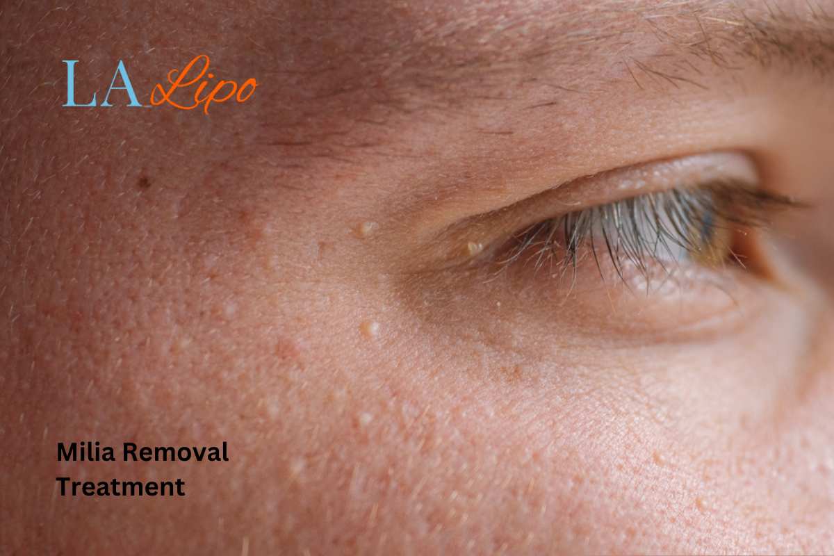 Cryopen Milia Removal: Is It the Easiest and Safest Option Shepperton?