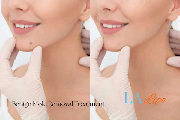 Before-and-after results following benign mole-removal treatment Shepperton