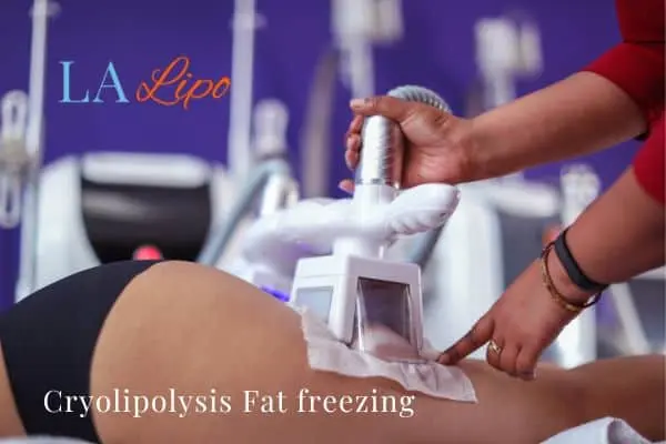 women getting fat freezing Shepperton