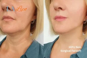 hi-fu for wrinkles Shepperton before and after results