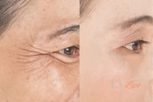 Before and after results of woman - HI-fu wrinkles reduction treatment Shepperton