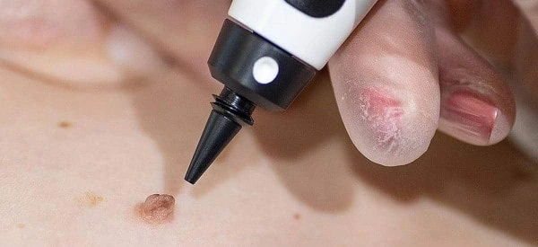 skin tag removal using cryopen Shepperton