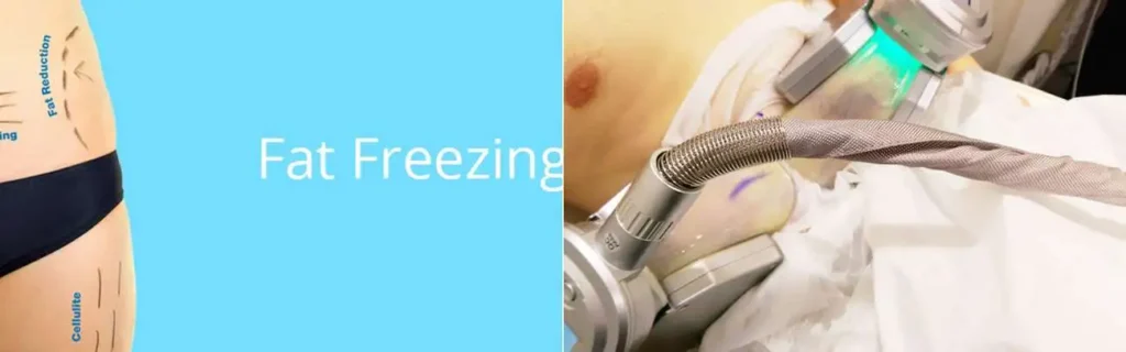 Fat freezing Shepperton on multiple areas of the body