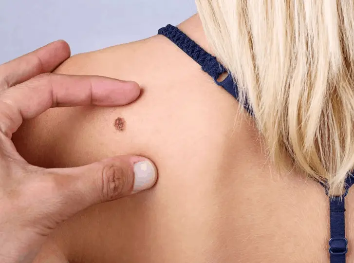 woman having mole removal Shepperton consultation before treatment.