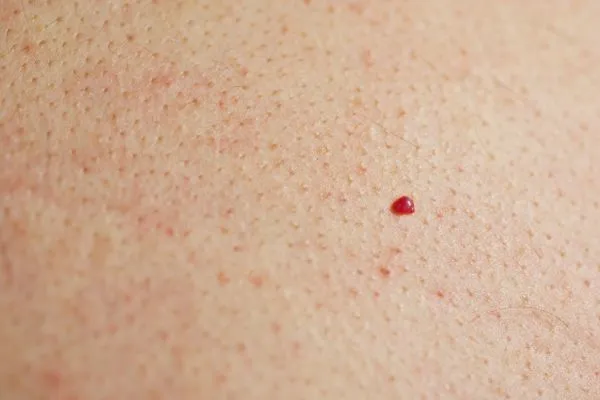 close up of a cherry angioma Shepperton