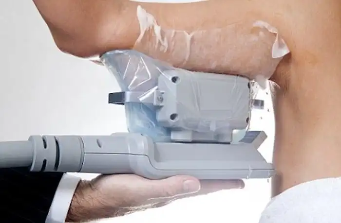 Picture of fat freezing Shepperton on the upper arms.