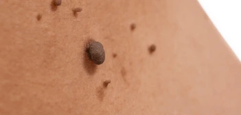 image of a skin tag Shepperton