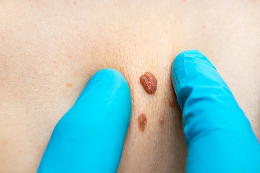Consultant examining a skin tag Shepperton