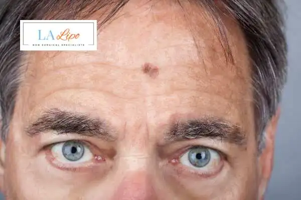 Solar Lentigo Removal Shepperton image of man with mark on his forehead