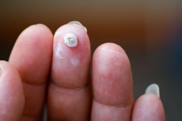 wart on person finger - cryotherapy to treat from LA LIPO Shepperton