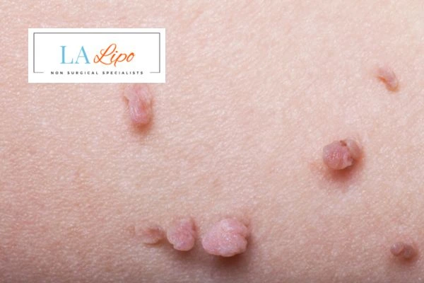 Does cryopen skin tag removal Shepperton hurt? Find out now call our team today!