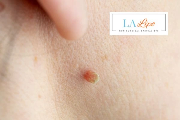 Book skin tag removal Shepperton today speak to our team now!