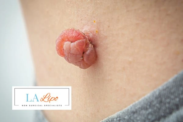 Interested in skin tag removal Shepperton? Concerned about the pain? Find out more today!
