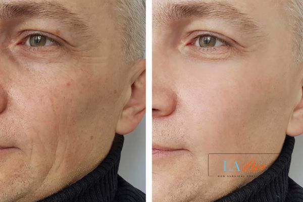 See the amazing results of Morpheus8 Treatment Shepperton!