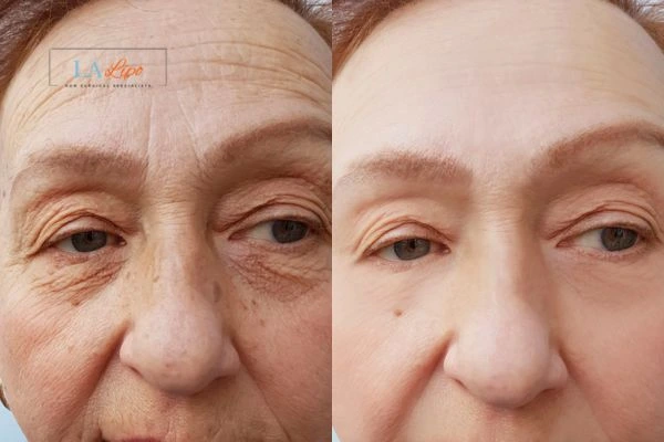 The powerful benefits of Morpheus8 Treatment Shepperton - Call Our team today!