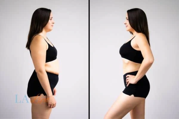 Picture of womans before and after using LA-EMS body sculpting to improve her core strength Shepperton