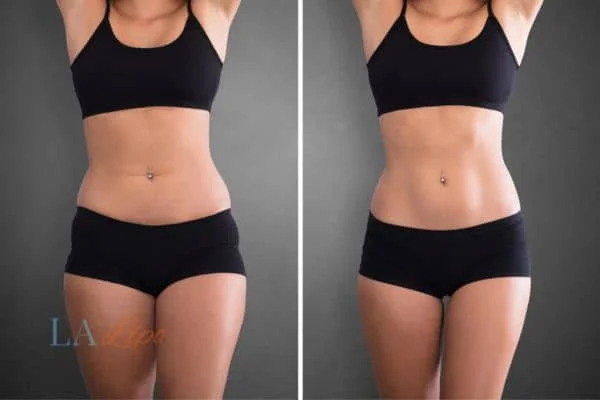 before and after results of non-surgical treatment to help a woman's body image and mental health Shepperton