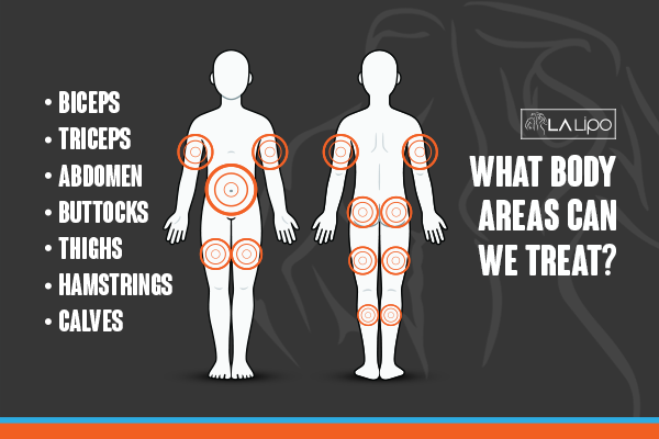 Diagram to show areas you can have LA-EMS Body Sculpting Treatment Shepperton