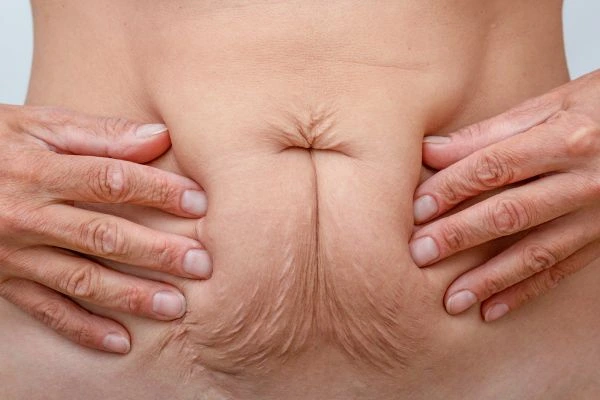 Should I Combine Diastasis Recti Treatment with Body Contouring for Better Results Shepperton?