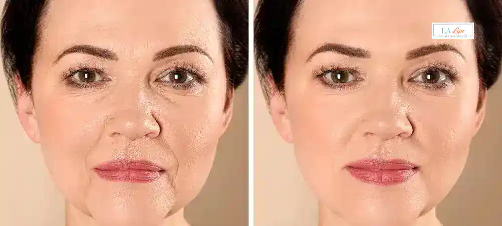 How Long Does It Take to See Results and How Long Do They Last Shepperton?