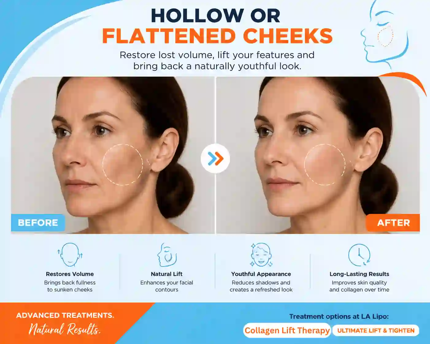 Sign #4: Hollow or Flattened Cheeks Shepperton